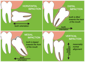 impaction-types