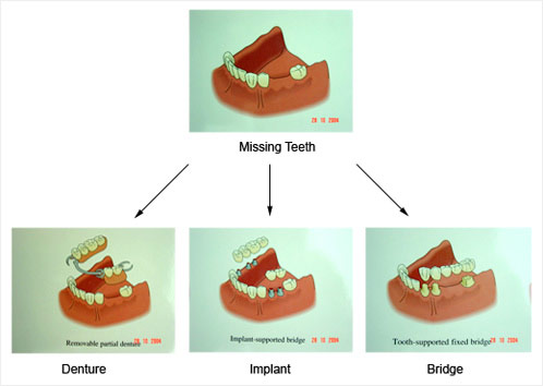 Dental implants, Denture & Bridge