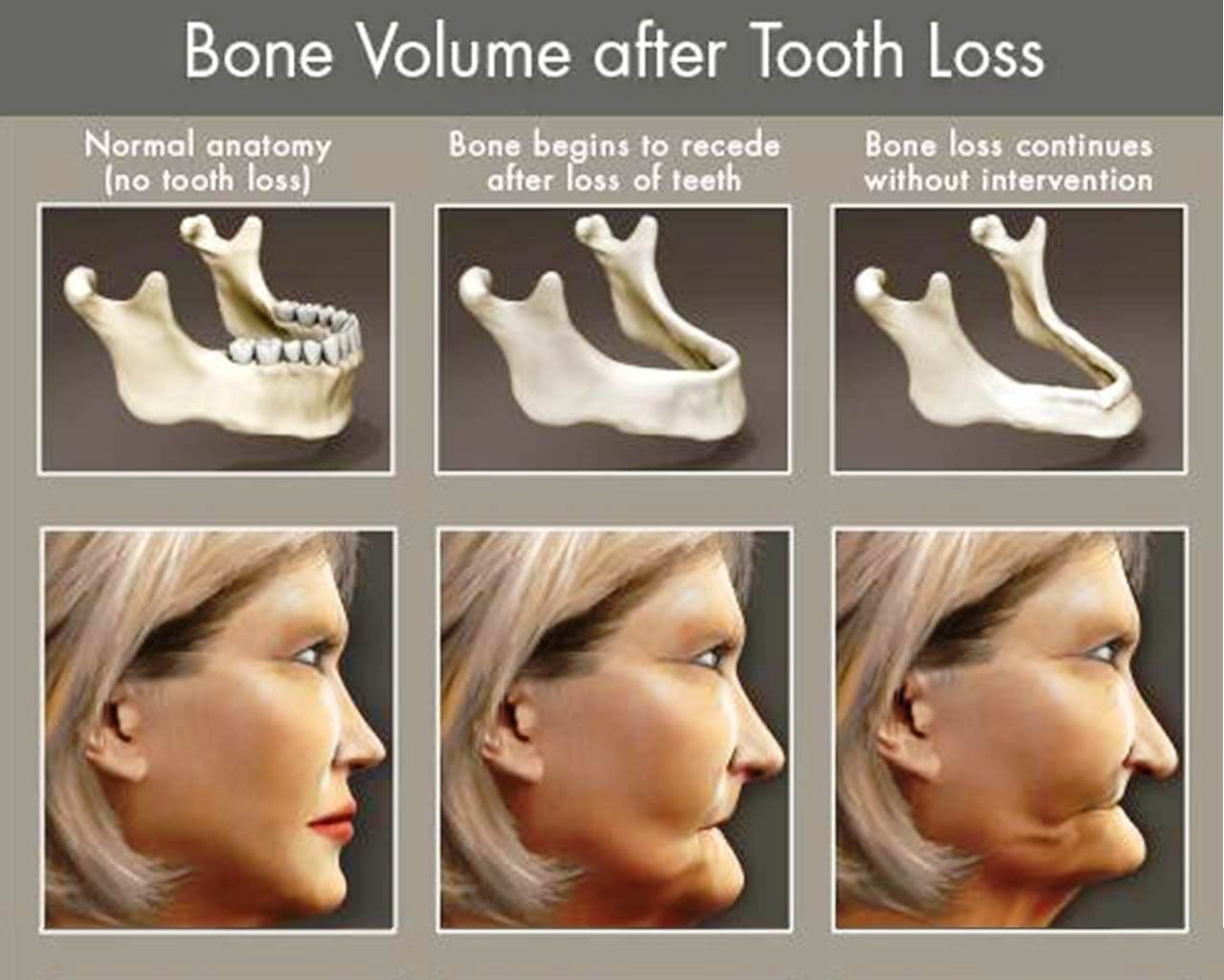 Dental Treatment Bone Grafting Coden Specialists